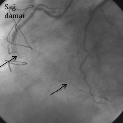 Bypass ameliyatı olmuş bir hastanın sağ damara bacaktan alınarak bağlanan bypass damarı