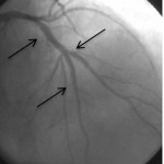 LAD damarı orta kısmına uzun, yan damar ağzına kısa stent çatal şeklinde yerleştirilerek kompleks darlık açıldı.
